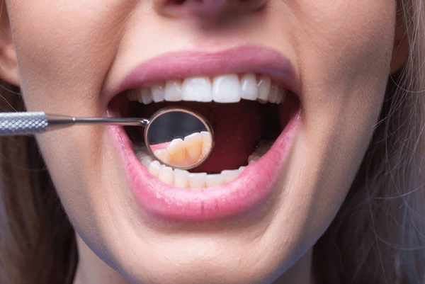 dental fillings for kids near you