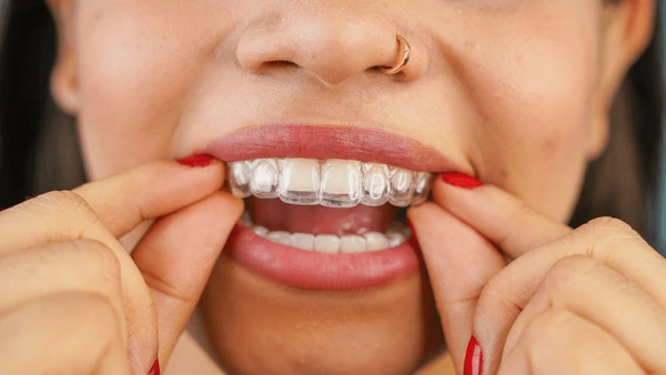 invisalign near you
