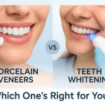 whats-the-difference-between-dental-veneers-and-teeth-whitening