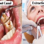 when-should-you-see-a-dentist-for-a-root-canal-vs-tooth-extraction