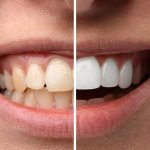 dental veneers vs crowns in red deer which one is right for you